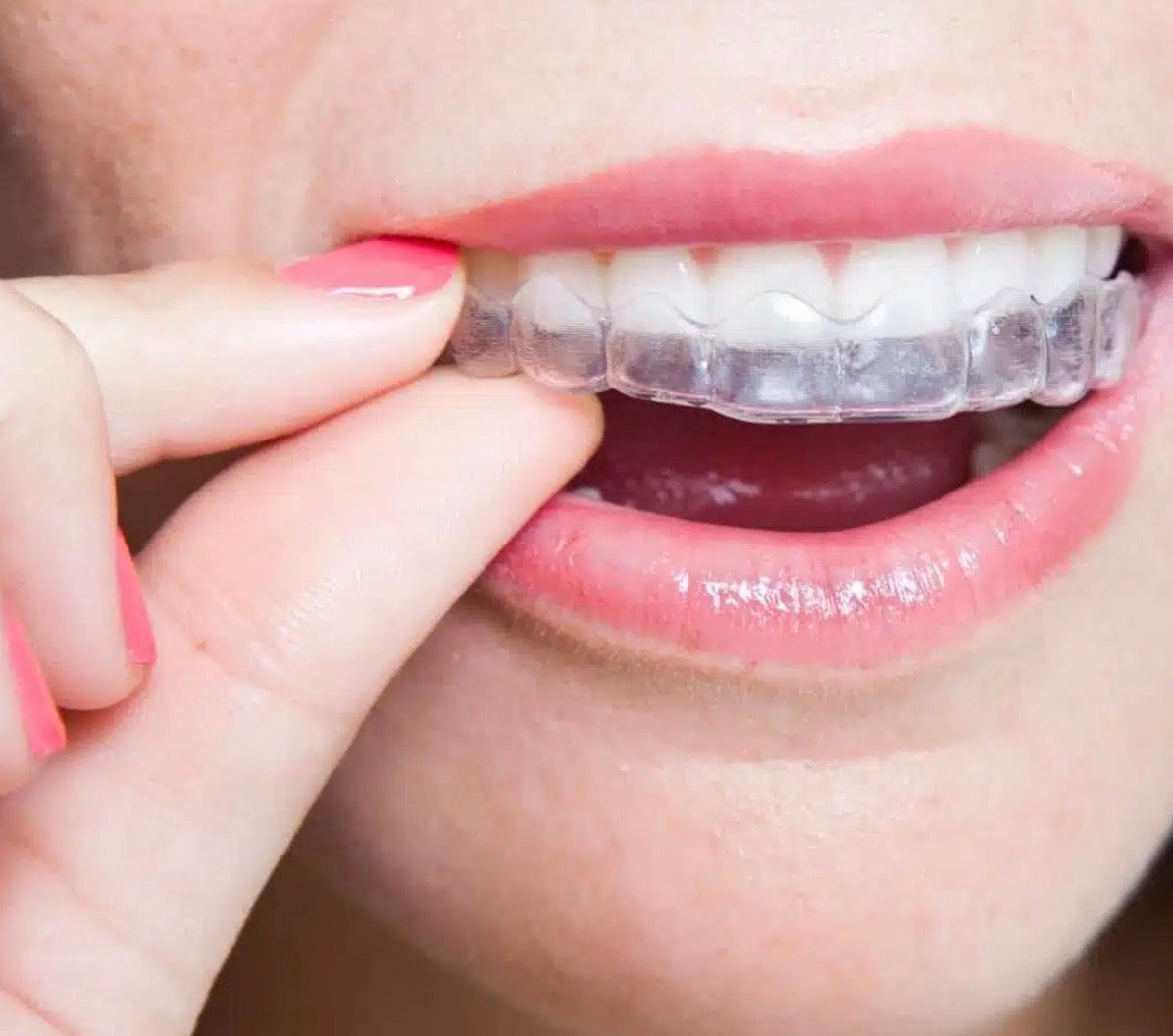 At Home Whitening Kit with Custom Trays