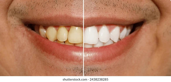 At Home Whitening Kit | 11%